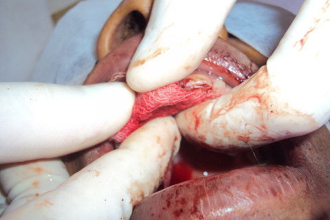 Acomodando tecido mocuperiostal