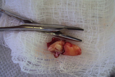 Elemento dental após exodontia