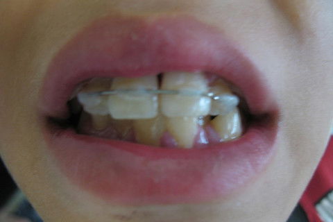 Após colagem do provisório com resina numa contenção de fio de orto.