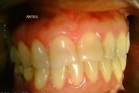 Antes clareamento luz natural