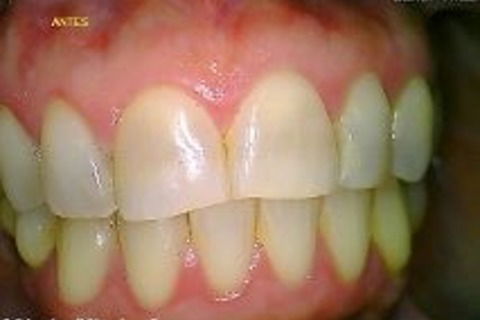 Antes clareamento luz câmera