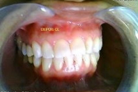 Depois clareamento luz câmera