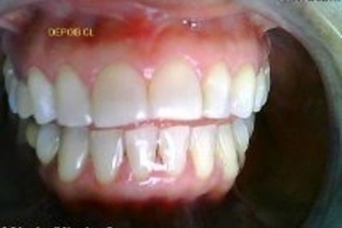 Depois clareamento luz câmera