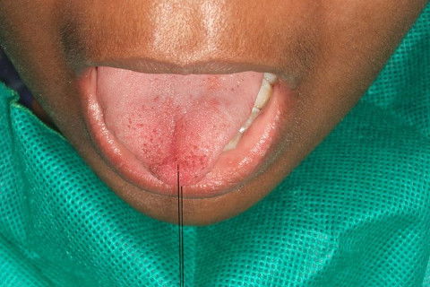 TRACIONAMENTO COM O FIO AGUALHADO