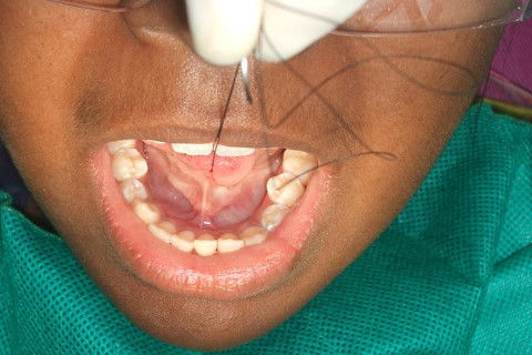 POSIÇÃO PARA REALIZAR A FRENECTOMIA