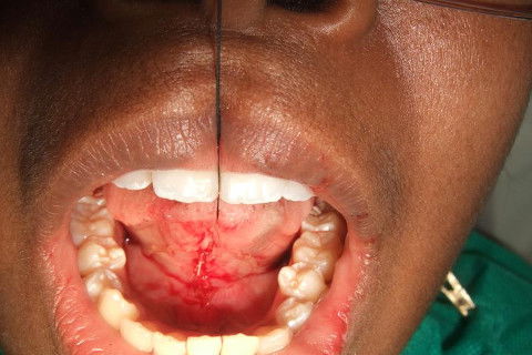 COM A SUTURA FOI UTILIZADO CAT GUT