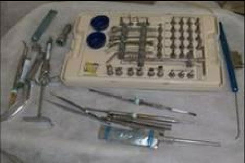 Reabilitação Oral com Instalação de Impante Unitário em Região de Maxila Superior Direita