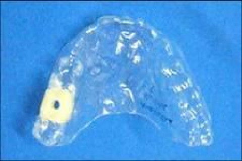 Reabilitação Oral com Instalação de Impante Unitário em Região de Maxila Superior Direita