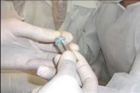 Reabilitação Oral com Instalação de Impante Unitário em Região de Maxila Superior Direita