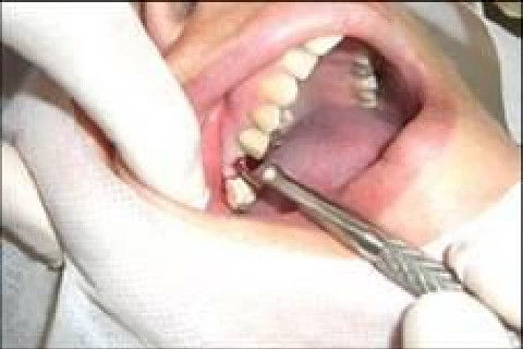 Reabilitação Oral com Instalação de Impante Unitário em Região de Maxila Superior Direita