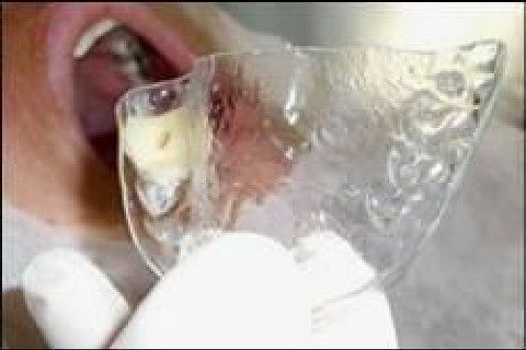 Reabilitação Oral com Instalação de Impante Unitário em Região de Maxila Superior Direita