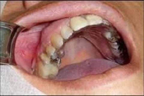 Reabilitação Oral com Instalação de Impante Unitário em Região de Maxila Superior Direita