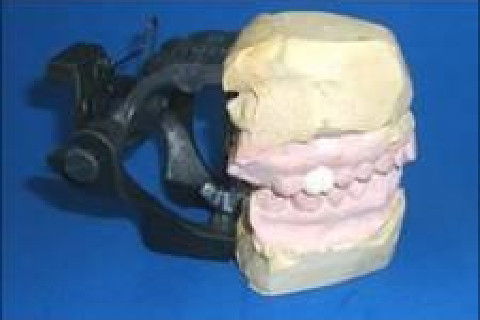 Reabilitação Oral com Instalação de Impante Unitário em Região de Maxila Superior Direita