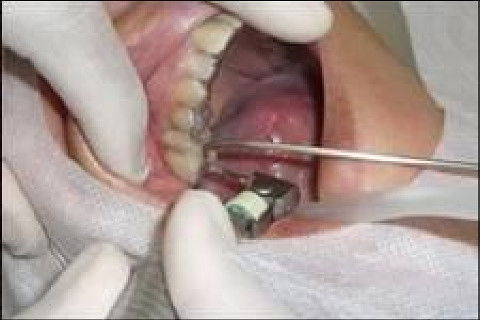 Reabilitação Oral com Instalação de Impante Unitário em Região de Maxila Superior Direita