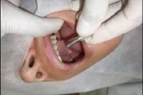 Reabilitação Oral com Instalação de Impante Unitário em Região de Maxila Superior Direita