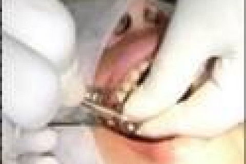 Reabilitação Oral com Instalação de Impante Unitário em Região de Maxila Superior Direita