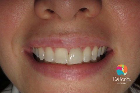 Caso Final / Sorriso Final