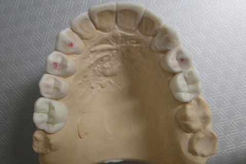 Enceramento Diagnóstico