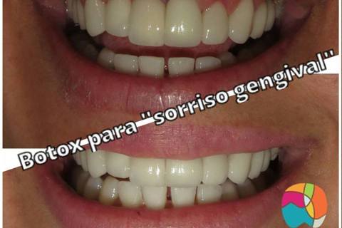 Comparação após Toxina Botulínica, finalizando o caso com sucesso.