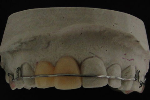 Placa Hawley para provisório pós implantes