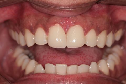 Fechamento de Diastema com Resina Composta