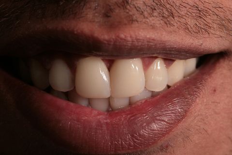 Fechamento de Diastema com Resina Composta