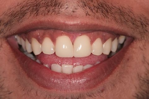 Fechamento de Diastema com Resina Composta