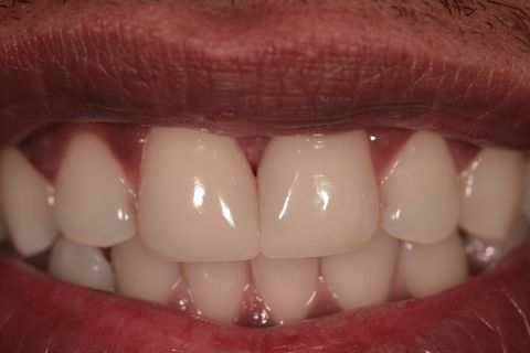 Fechamento de Diastema com Resina Composta