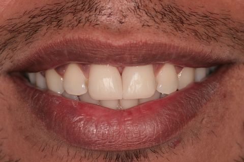 Restauração sem acabamento e polimento