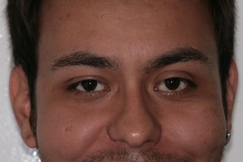 Fechamento de Diastema com Resina Composta