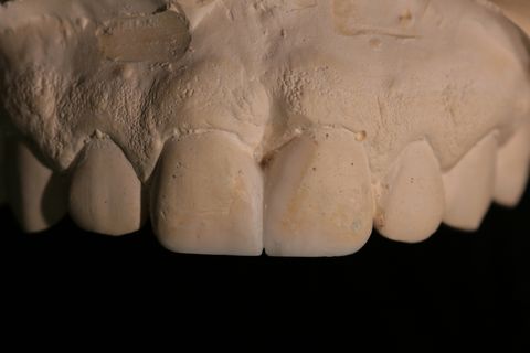 Enceramento Diagnóstico