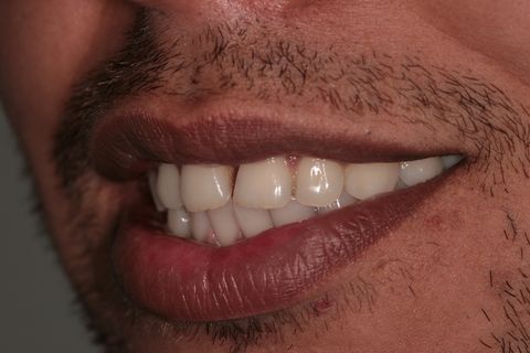 Fechamento de Diastema com Resina Composta
