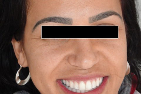 Tratamento Ortodôntico Não Cirúrgico de Classe Iii em Paciente Adulto