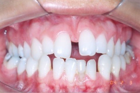 Tratamento Ortodôntico Não Cirúrgico de Classe Iii em Paciente Adulto