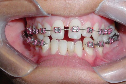 Tratamento Ortodôntico Não Cirúrgico de Classe Iii em Paciente Adulto