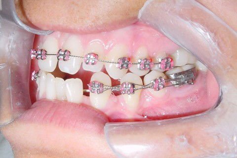 Tratamento Ortodôntico Não Cirúrgico de Classe Iii em Paciente Adulto