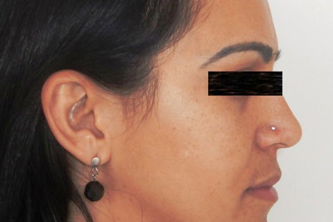 Tratamento Ortodôntico Não Cirúrgico de Classe Iii em Paciente Adulto