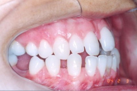 Tratamento Ortodôntico Não Cirúrgico de Classe Iii em Paciente Adulto