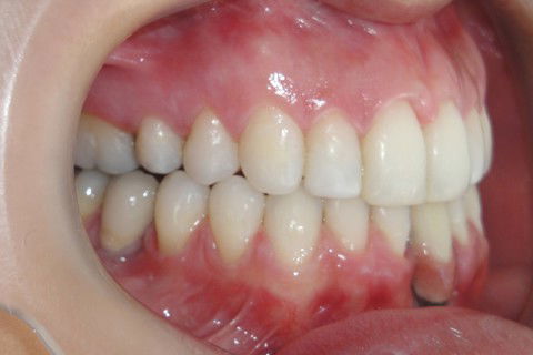 Tratamento Ortodôntico Não Cirúrgico de Classe Iii em Paciente Adulto