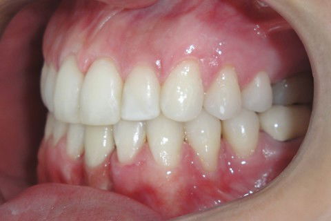 Tratamento Ortodôntico Não Cirúrgico de Classe Iii em Paciente Adulto