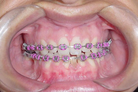 Tratamento Ortodôntico Não Cirúrgico de Classe Iii em Paciente Adulto