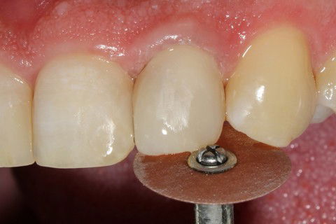 Acabamento e polimento