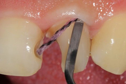 Fio retrator para controlar umidade e visualização do término