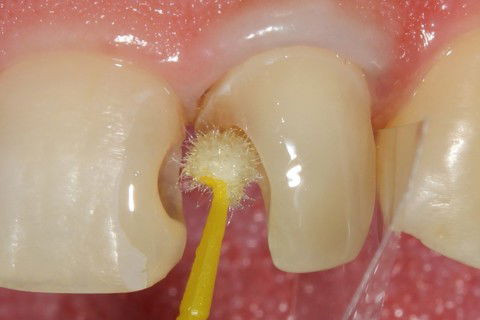 Aplicação de adesivo