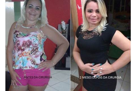 Cirurgia Ortognática Bimaxilar