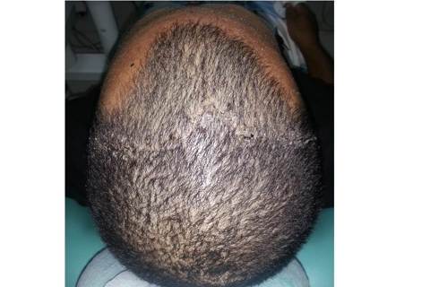 1mês de pós-operatório