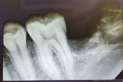 raio-x imediato pós exo 37/38