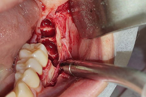 Leito cirúrgico após as exodontias