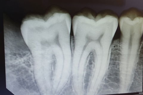 raio-x imediato pós exodontia 48