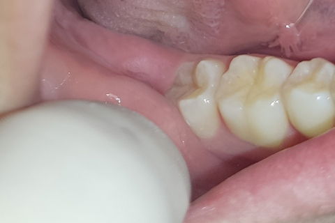 região do 48 antes da cirurgia